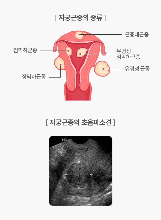 자궁근종 종류